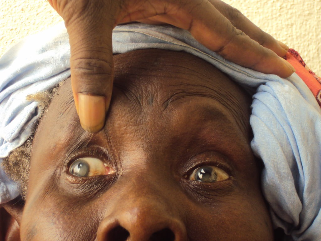 Journée mondiale de la vue : 165 000 aveugles et plus de 550 000 malvoyants au Sénégal