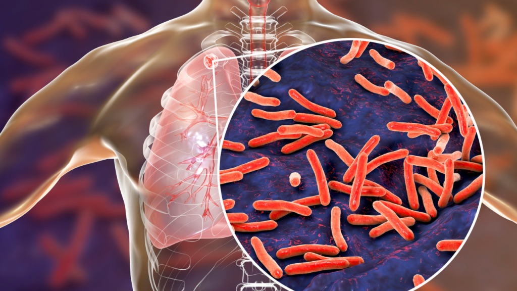 Tuberculose au Sénégal : 16 595 cas enregistrés en 2024