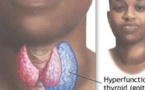 Plus de 70% des Sénégalais souffrent des maladies thyroïdiennes