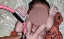 Inde: Un bébé « miracle » naît avec 4 bras et 4 jambes.